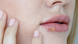 2019 Target Market Report on Cold Sore Treatment Among Millennials
