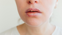 2020 Study of the Market for Cold Sore Treatment Products