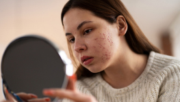 2024 Study of the Market for Acne Products Among Young Adults