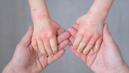 2020 Studies of the Market for Eczema: Adult & Pediatric